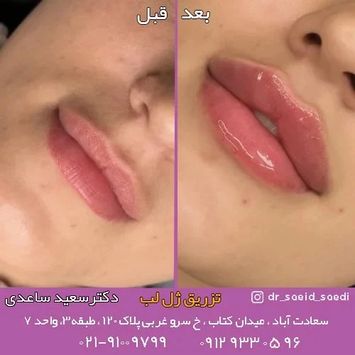 تزریق ژل لب چیست+هزینه و انواع آن