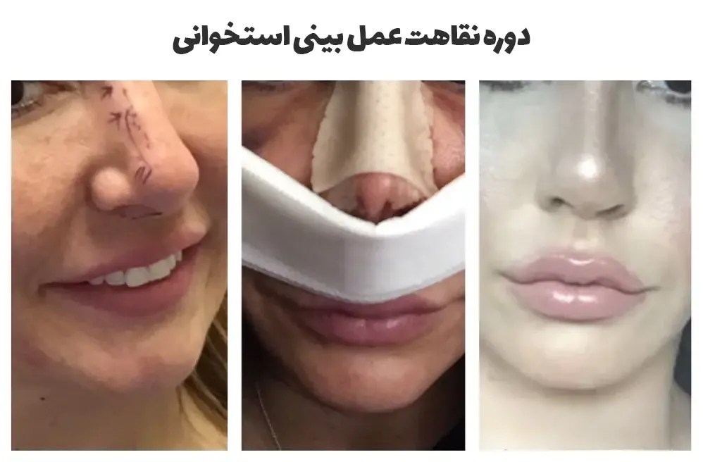 دوره نقاهت عمل بینی استخوانی