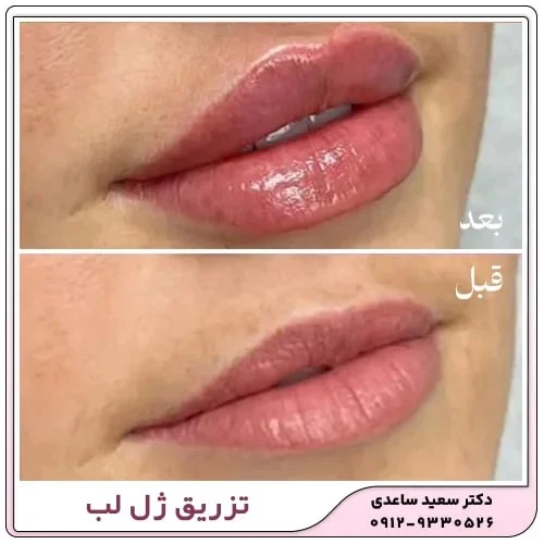 دوره نقاهت ژل لب : راهنمای جامع برای مراقبت و بهبودی