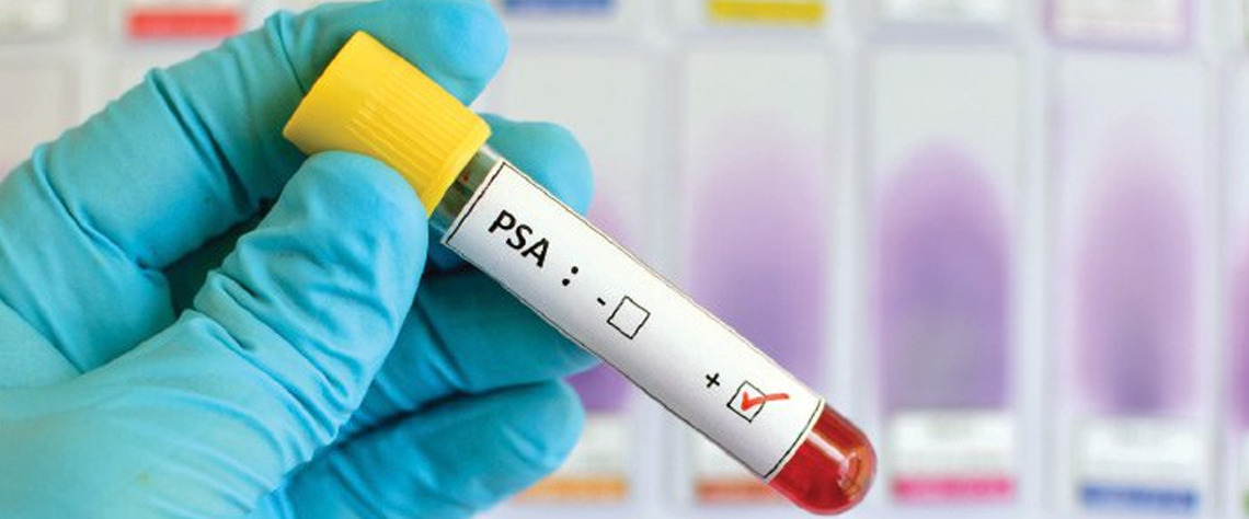 بیماری | آزمایش روشهای جدید چکاپ پروستات بدون درد در کلینیکهای معتبر
