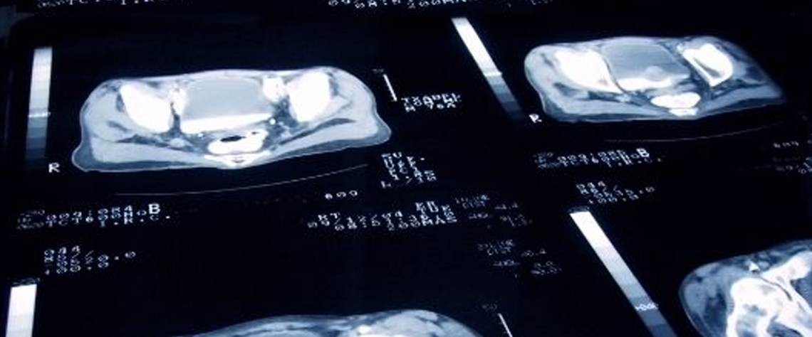 بیماری | آزمایش هزینه چکاپ پروستات بدون درد در کلینیکهای معتبر